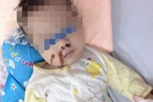 Dì cẩu thả, mẹ vô ý khiến bé 4 tháng tuổi nhập viện cấp cứu