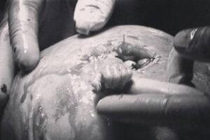 Đang hoàn tất ca sinh mổ thai ba, bác sĩ giật mình phát hiện còn một cánh tay nữa trong bụng mẹ