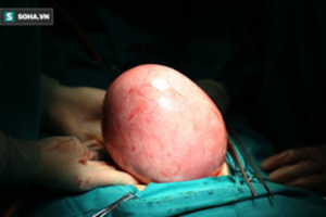 Cắt khối u lớn bằng gang tay trong ổ bụng một phụ nữ tại Hà Nội