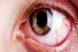 Bệnh Đau Mắt Đỏ Và Chửa Trị
