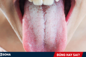 Có nên vệ sinh lưỡi mỗi lần đánh răng để ngừa hôi miệng: Nha sĩ trả lời rất thuyết phục