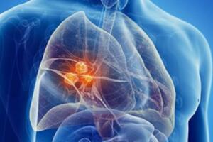 Ung thư phổi đang đứng đầu về tỉ lệ tử vong: Đây là nguyên nhân, dấu hiệu đừng nên bỏ qua