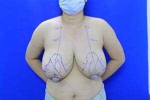 "Giải phóng" bộ ngực khủng gần 3kg cho nữ bệnh nhân 38 tuổi