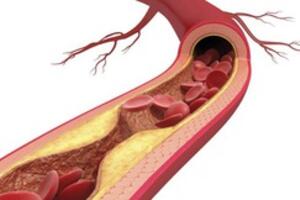 Nhóm thuốc statin làm giảm nguy cơ tử vong do các bệnh lý tim mạch ở nam giới