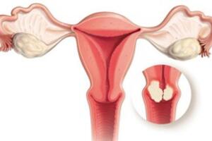 Những dấu hiệu cảnh báo sớm bệnh ung thư cổ tử cung: Mọi phụ nữ đều nên ghi nhớ chính xác