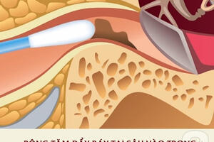 Đây là lý do tại sao bạn không bao giờ được dùng tăm bông để lấy ráy tai