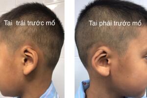 Lần đầu tiên sửa chữa dị tật “hai tai bỏ túi” bằng kỹ thuật mới