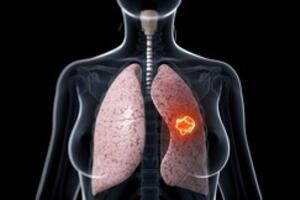 Bị ung thư phổi có thể sống được bao lâu: Bạn nên biết điều này để phòng bệnh hiệu quả