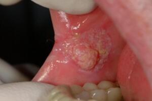 Những dấu hiệu nhận biết bệnh ung thư khoang miệng: Cần đi khám để phòng tránh sớm