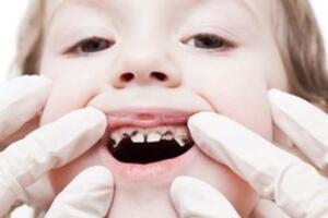 5 quan niệm sai lầm khiến trẻ bị hỏng răng ngay từ nhỏ, các bậc cha mẹ cần chú ý