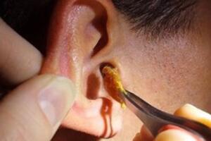 Trẻ giảm thính lực, tổn thương tai vì bố mẹ cố “nạo vét” ráy tai