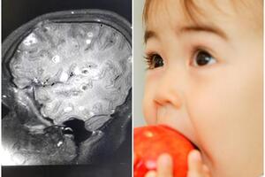 Bé 8 tuổi động kinh do nhiễm 100 trứng sán dây trong não vì có 2 thói quen tai hại