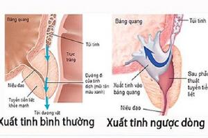 Các rối loạn xuất tinh làm ảnh hưởng tới khả năng sinh sản