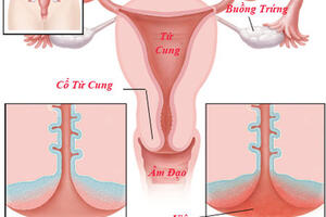 Điều trị viêm lộ tuyến cổ tử cung: những điều chị em cần biết