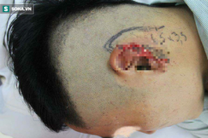 Hà Nội: Thanh niên ngồi nhậu bị bạn nhậu cắt đứt tai