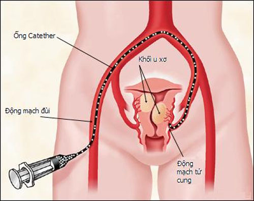 Triệu chứng nhận biết bệnh u xơ tử cung 1