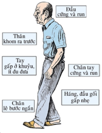 Biểu hiện của người mắc bệnh Parkinson.