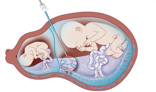 Tùy tiện sử dụng thuốc kích trứng: Nguy hiểm khôn lường  2