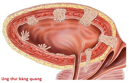 Ung thư bàng quang 