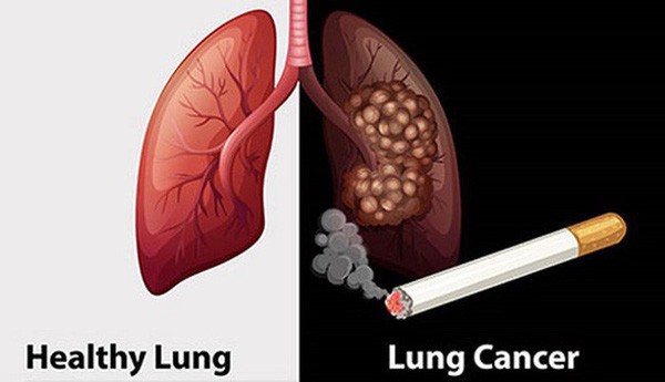 Người có 6 thói quen này có tỉ lệ mắc ung thư phổi rất cao: Hãy xem có bạn không để tránh! - Ảnh 2.