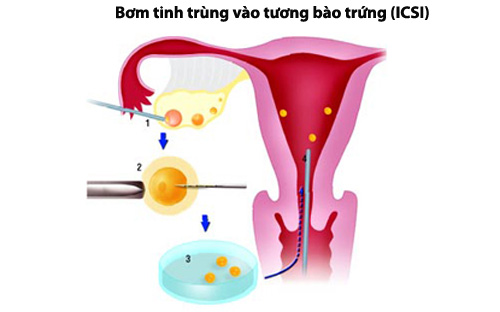 Phương pháp hỗ trợ các cặp vợ chồng hiếm muộn nhanh có thai 2