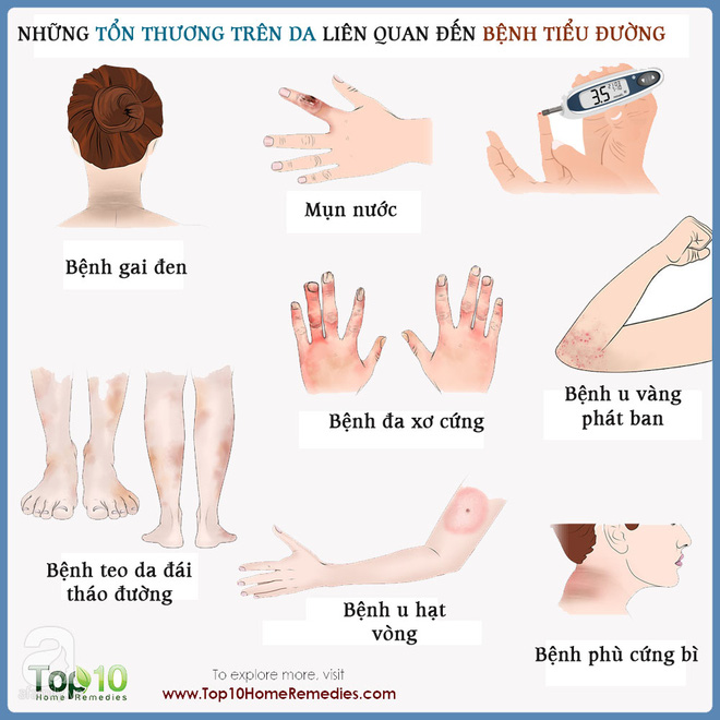 Những tổn thương trên da liên quan đến bệnh tiểu đường: Nhìn là nhận ra ngay - Ảnh 2.