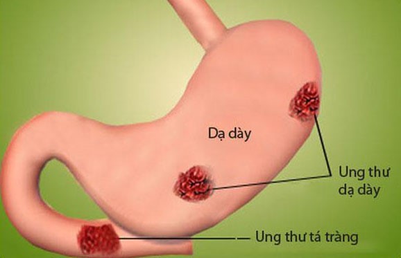 Cẩn trọng không lại rước vào thân những bệnh ung thư đường tiêu hóa từ chính chuyện ăn uống của bạn - Ảnh 2.