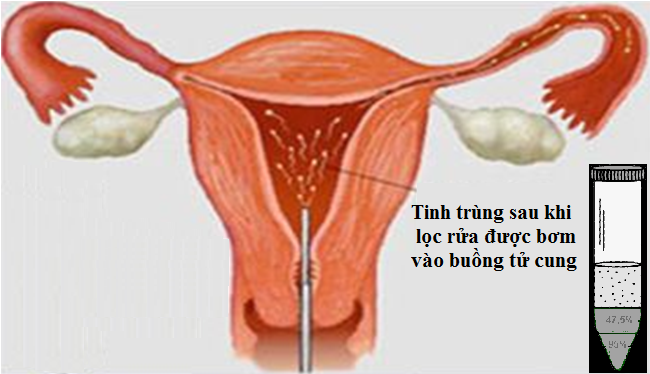 Sau khi làm IUI bị ra máu có làm sao không, có thụ thai được không? - Ảnh 2.