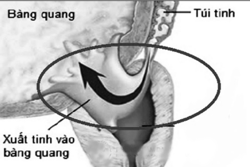 Xuất tinh ngược - một rối loạn tình dục ở bệnh nhân đái tháo đường.