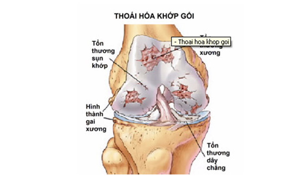 Thoái hóa khớp: căn bệnh nguy hiểm ở mọi lứa tuổi 2