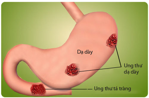 6 điều quan trọng về viêm loét dạ dày ai cũng cần biết 1