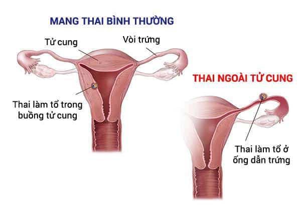 Tắc kinh và đau bụng kèm ra máu: BS sản khoa cảnh báo nguy cơ khiến chị em vô sinh - Ảnh 1.