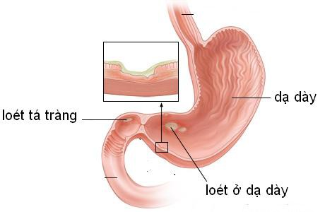 Chủ quan nghĩ đau bụng do viêm loét, đi khám thành ung thư dạ dày - Ảnh 2.