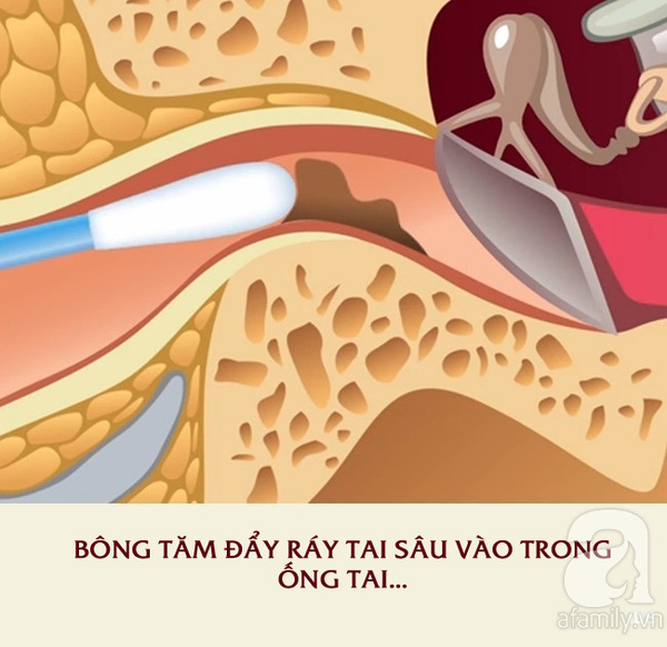 không dùng tăm bông lấy ráy tai