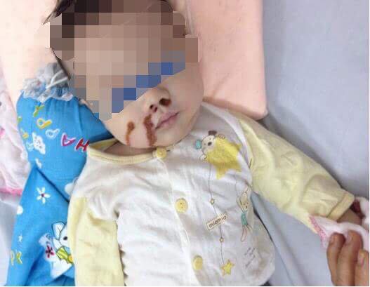 Dì cẩu thả, mẹ vô ý khiến bé 4 tháng tuổi nhập viện cấp cứu - Ảnh 1.