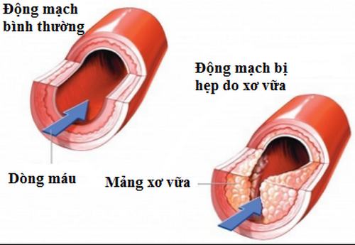 Mảng bám gây hẹp lòng động mạch