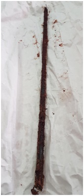 thanh sắt dài 40cm đâm xuyên bụng bệnh nhân