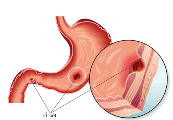 Món ăn chữa loét dạ dày - tá tràng - Ảnh 1.