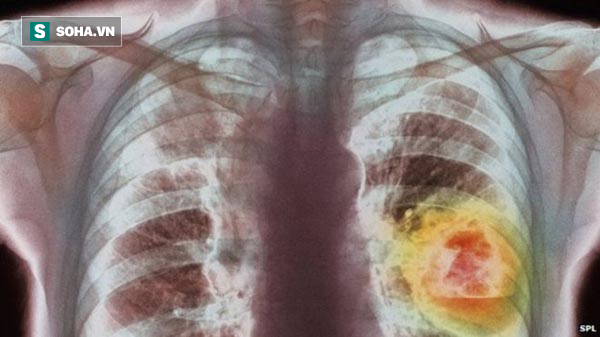 Người có 6 thói quen này có tỉ lệ mắc ung thư phổi rất cao: Hãy xem có bạn không để tránh! - Ảnh 1.