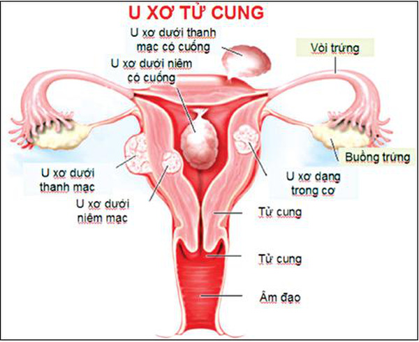 u xơ tử cung