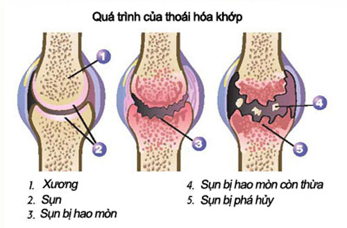 Bí quyết ăn uống phòng ngừa thoái hóa khớp 1