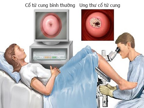 Dấu hiệu sớm của ung thư cổ tử cung - Ảnh 1.