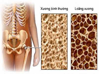 15 nhóm bệnh đe dọa sức khỏe người cao tuổi - Ảnh 4.