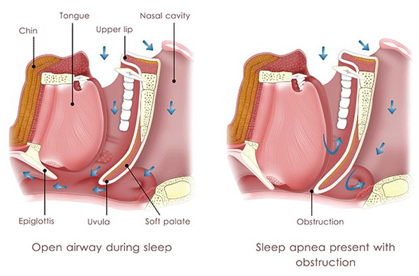 ngủ ngáy có hại sức khỏe 2