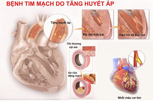 BS khuyến cáo: Người cao huyết áp tuyệt đối không làm này kẻo đột quỵ mất mạng có ngày - Ảnh 3.