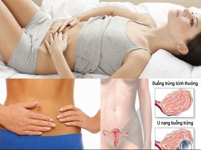 Những điều chị em chưa biết về hội chứng buồng trứng đa nang 2