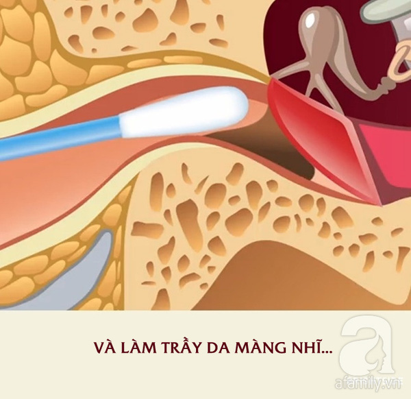 không dùng tăm bông lấy ráy tai