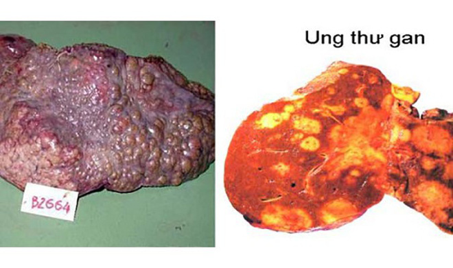 Bác sĩ Bệnh viện K chia sẻ các dấu hiệu vàng cảnh báo bệnh ung thư gan - Ảnh 1.
