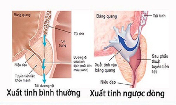 Các rối loạn xuất tinh làm ảnh hưởng tới khả năng sinh sản - Ảnh 1.