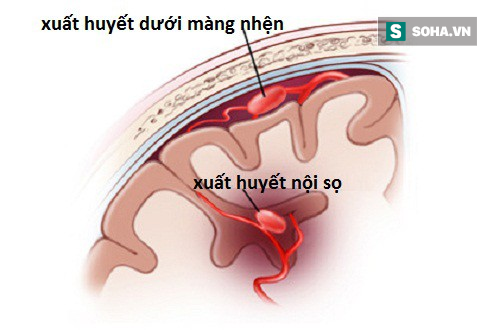 Tưởng cảm lạnh bỗng tử vong đột ngột: BS cảnh báo có dấu hiệu này tới viện ngay kẻo muộn - Ảnh 2.